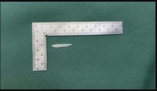 The bone that was extracted